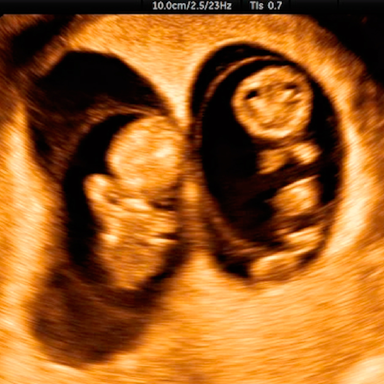 Tamizaje 1er Trimestre Múltiple